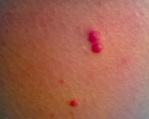 почему появляются красные точки на теле фото