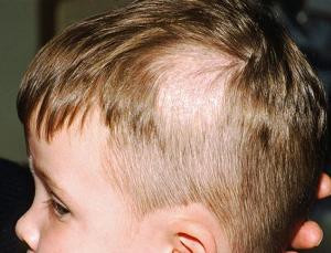 стриженный лишай у ребенка фото