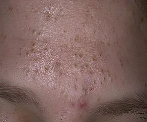 закрытые комедоны фото