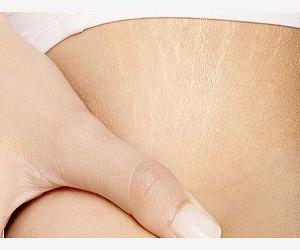 растяжки на животе фото