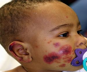 геморрагический васкулит у детей лечение фото