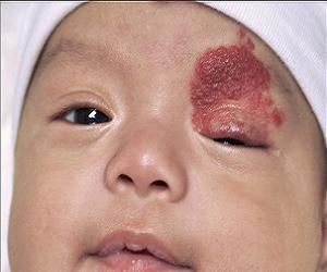 гемангиома у новорожденных фото