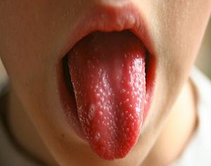 скарлатина симптомы у детей язык фото