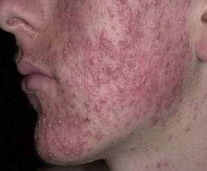 акне новорожденных фото