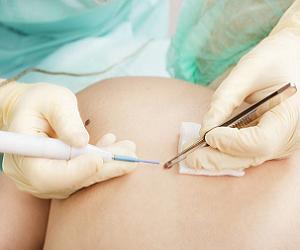 папилломатозный невус фото