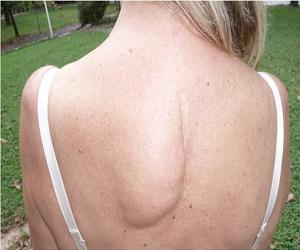 липома на голове фото