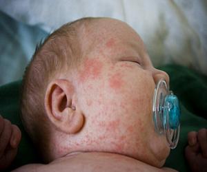 сыпь на теле у ребенка фото