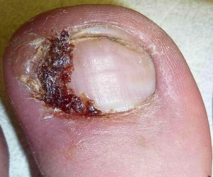 коррекция вросшего ногтя