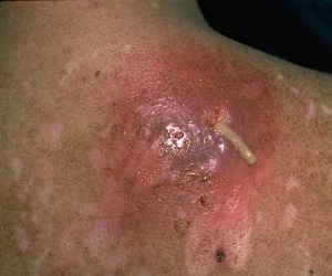 карбункул симптомы и лечение фото