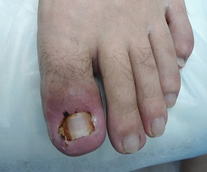 как вылечить нарыв на пальце ноги