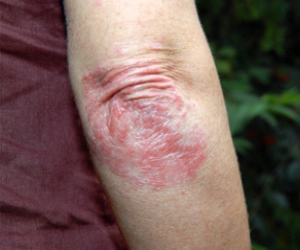 как лечить псориаз фото