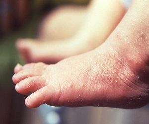 как выглядит экзема на ногах фото