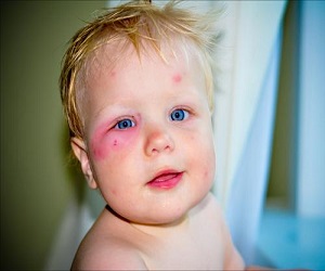 укусы комаров у детей