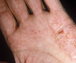 сухая экзема лечение фото