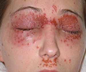 экзема на лице фото лечение