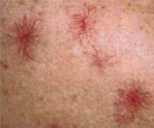 сосудистые звездочки на лице фото