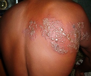 фото опоясывающего лишая у человека