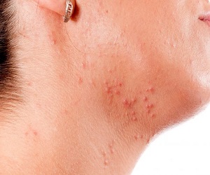 прыщи на шее лечение