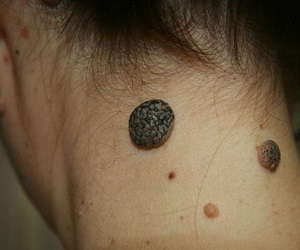 какие родинки опасны для здоровья фото