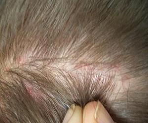 прыщи на голове в волосах фото