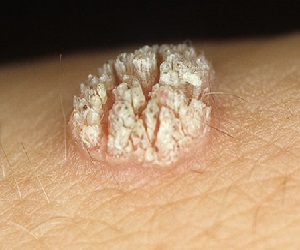 папилломы на шее лечение