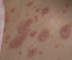 розовый лишай при беременности