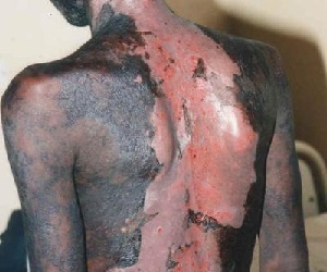 синдром лайелла причины