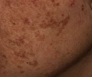 хлоазма лечение