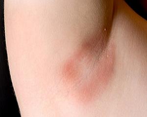 как избавиться от раздражения под мышками