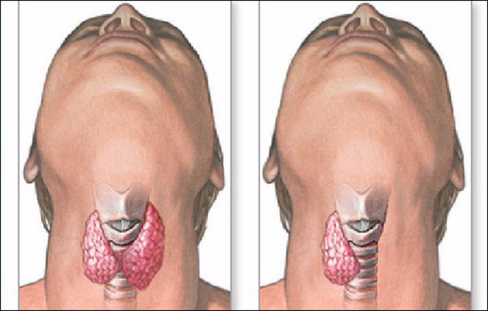 Увеличение щитовидной железы