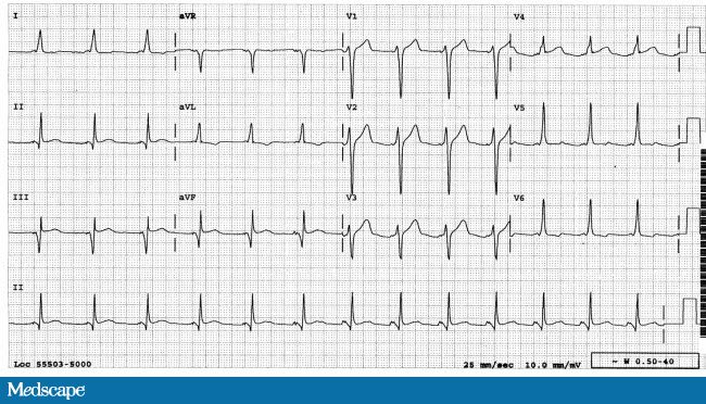 ЭКГ при синдроме укороченного PQ