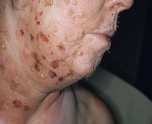 вирусная пузырчатка фото