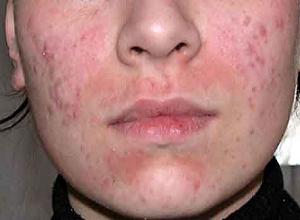 демодекоз фото на лице