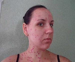 ветрянка у взрослых осложнения фото