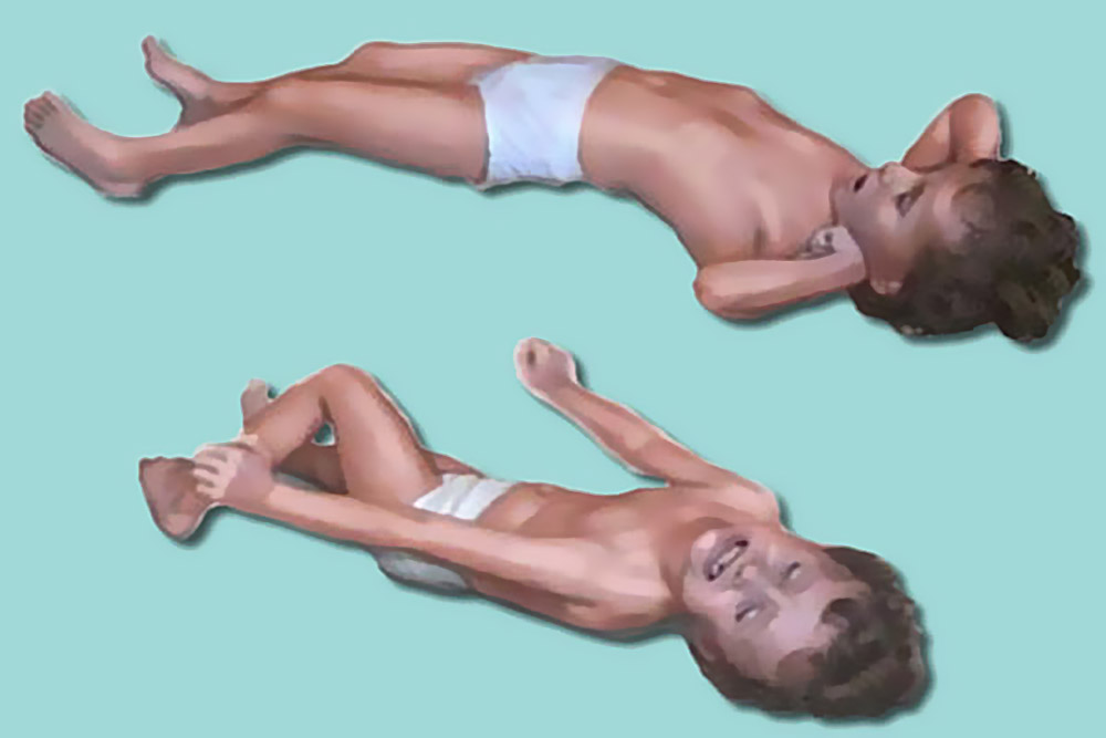 Приступ эпилепсии