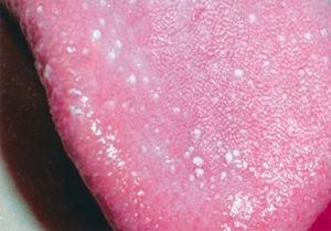 прыщ на корне языка фото