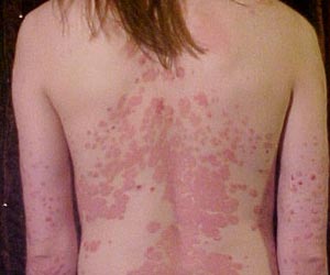 симптомы крапивницы у взрослых фото