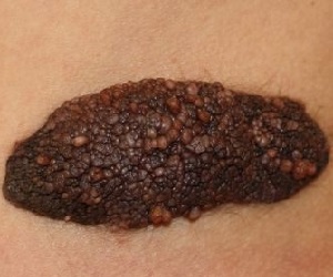 папилломатозный невус