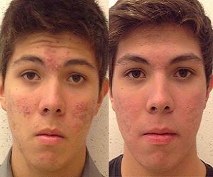 роаккутан отзывы фото до и после