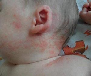 сыпь у детей лечение фото