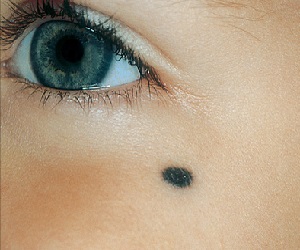 диспластический невус