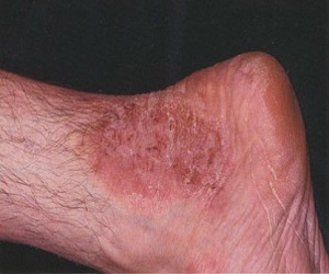 атопический дерматит у взрослых лечение