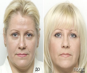 плазмолифтинг отзывы фото до и после