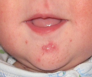 прыщи на подбородке у детей