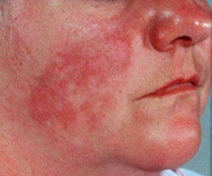 системная красная волчанка прогноз