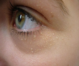 милиумы лечение