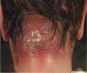 карбункул осложнения