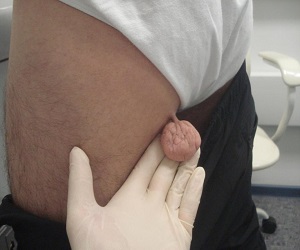 фиброма на ноге