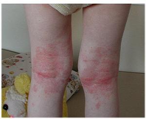 нейродермит у детей лечение фото