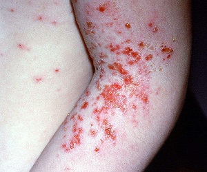 чесотка у детей фото